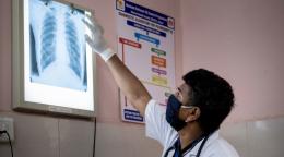 Мужчина в медицинской маске изучает рентгеновский снимок груди