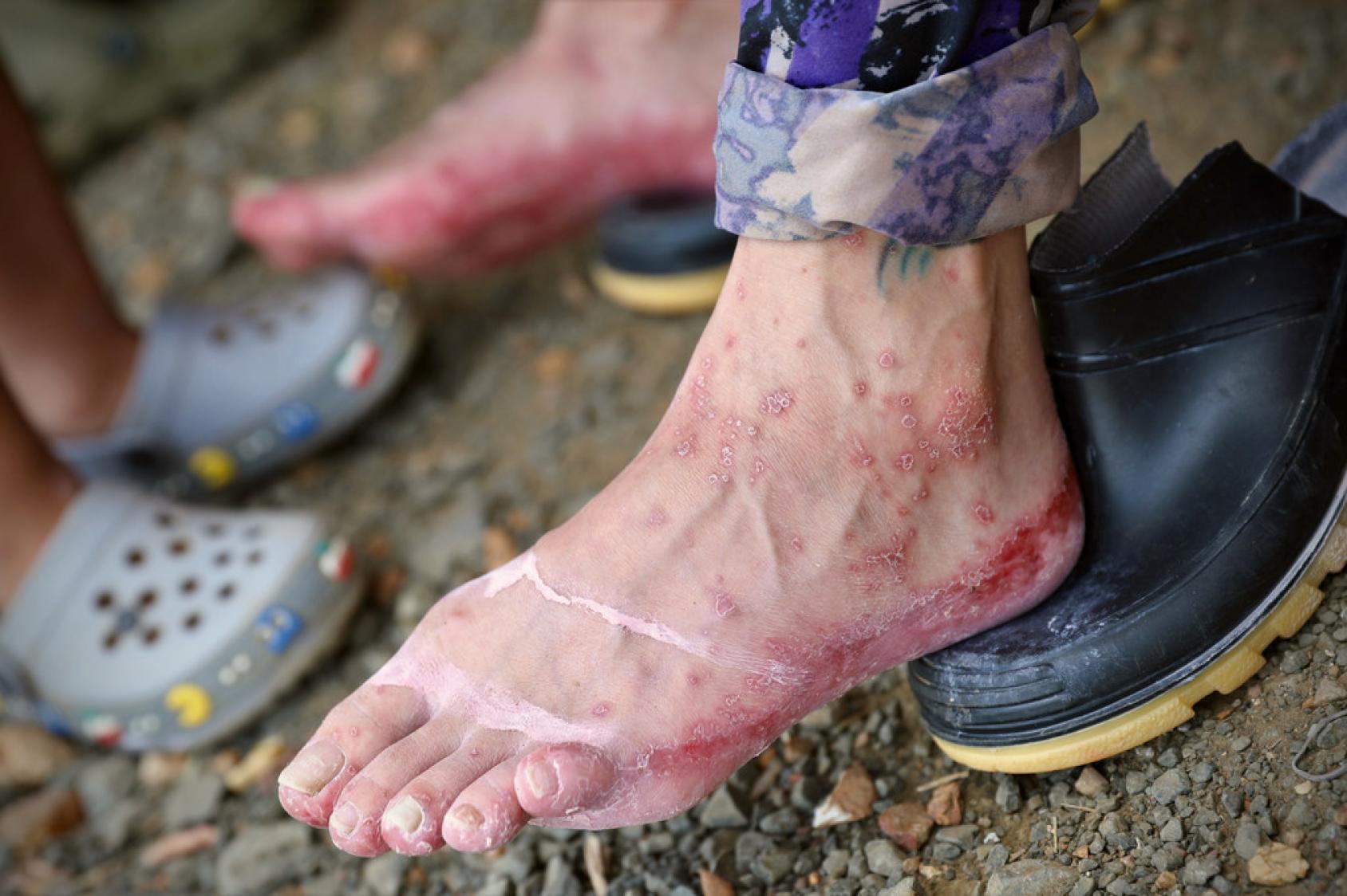 Migrante con los pies llenos de sangre
